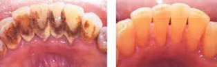 Dental cleaning in delhi, dental scaling and polishing in delhi