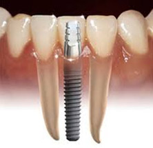 Dental implants
