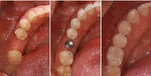 Dental implants