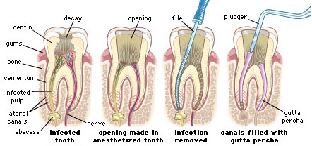 Root Canal Treatment, Root Canal Treatment In Delhi