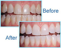 Tooth whitening In Delhi, Teeth whitening In Delhi