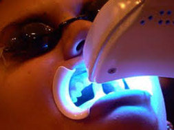 best dentist in delhi, Teeth whitening In South Delhi