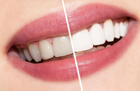 Dental Teeth Bleaching, Cosmetic Dentistry India Dental Teeth Bleaching, Cosmetic Dentistry India