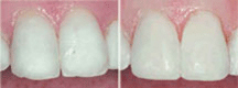 Dental Veneers Laminates, Porcelain laminate veneers, Porcelain Laminate Veneers in Delhi Dental Veneers Laminates, Porcelain laminate veneers, Porcelain Laminate Veneers in Delhi